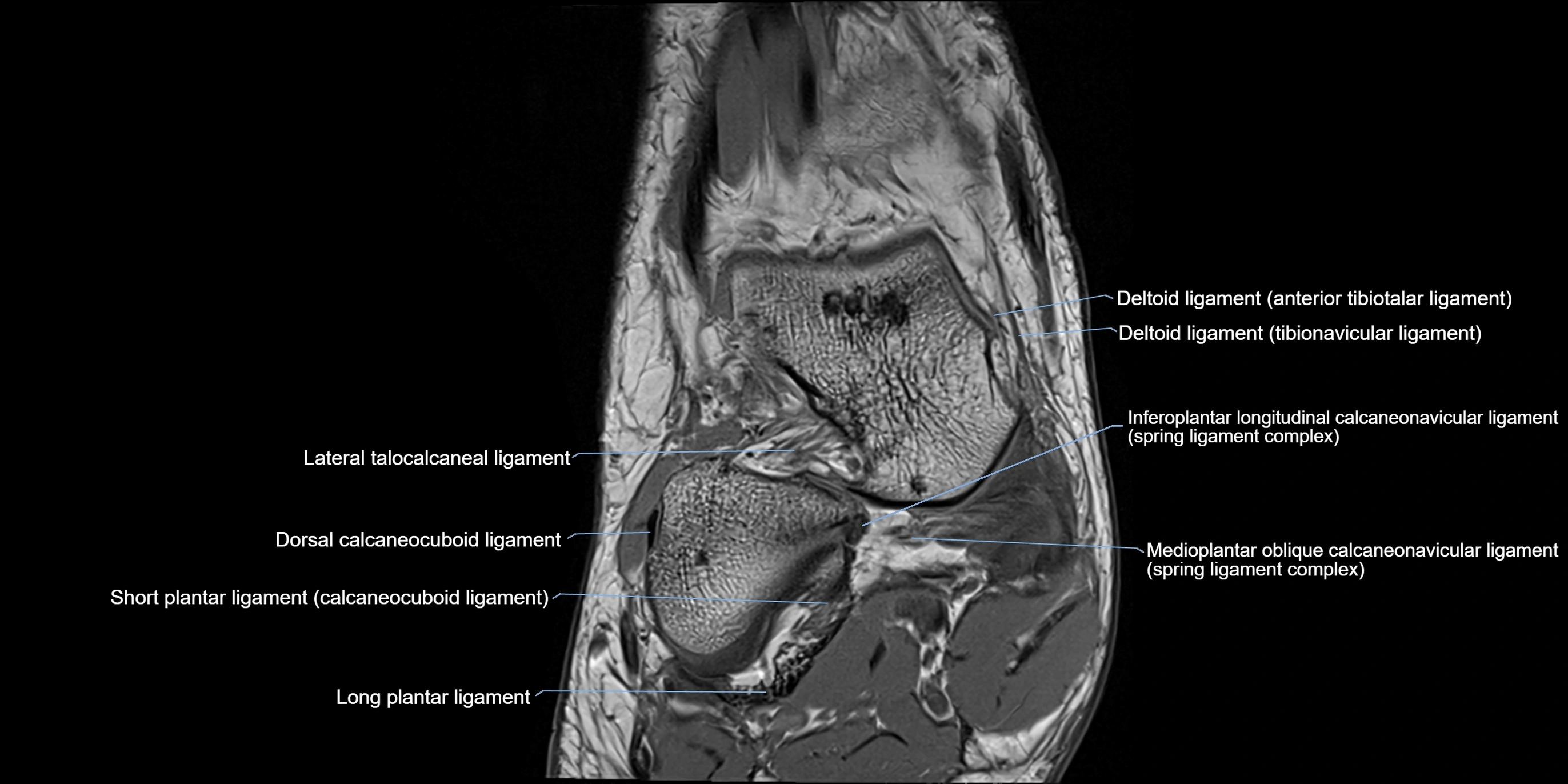 MRI Ankle coronal ligaments cross sectional anatomy 3T  radiology  image-img-00001-00005.webp